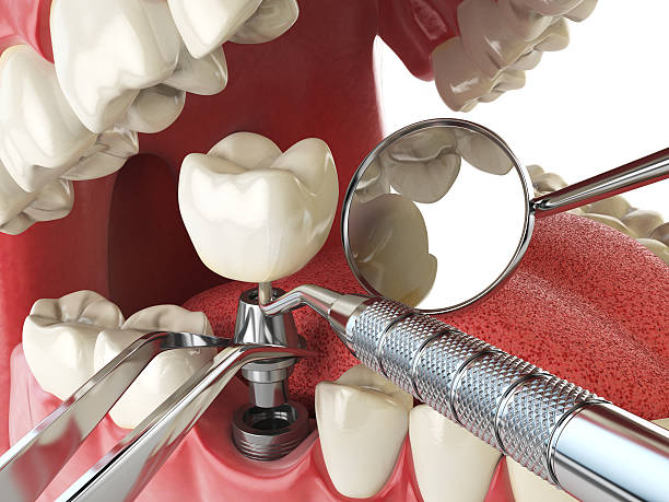 Best Emergency Treatment for Dental Infections or Abscesses in Colony Rk, PA